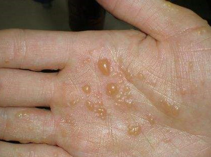 皮炎